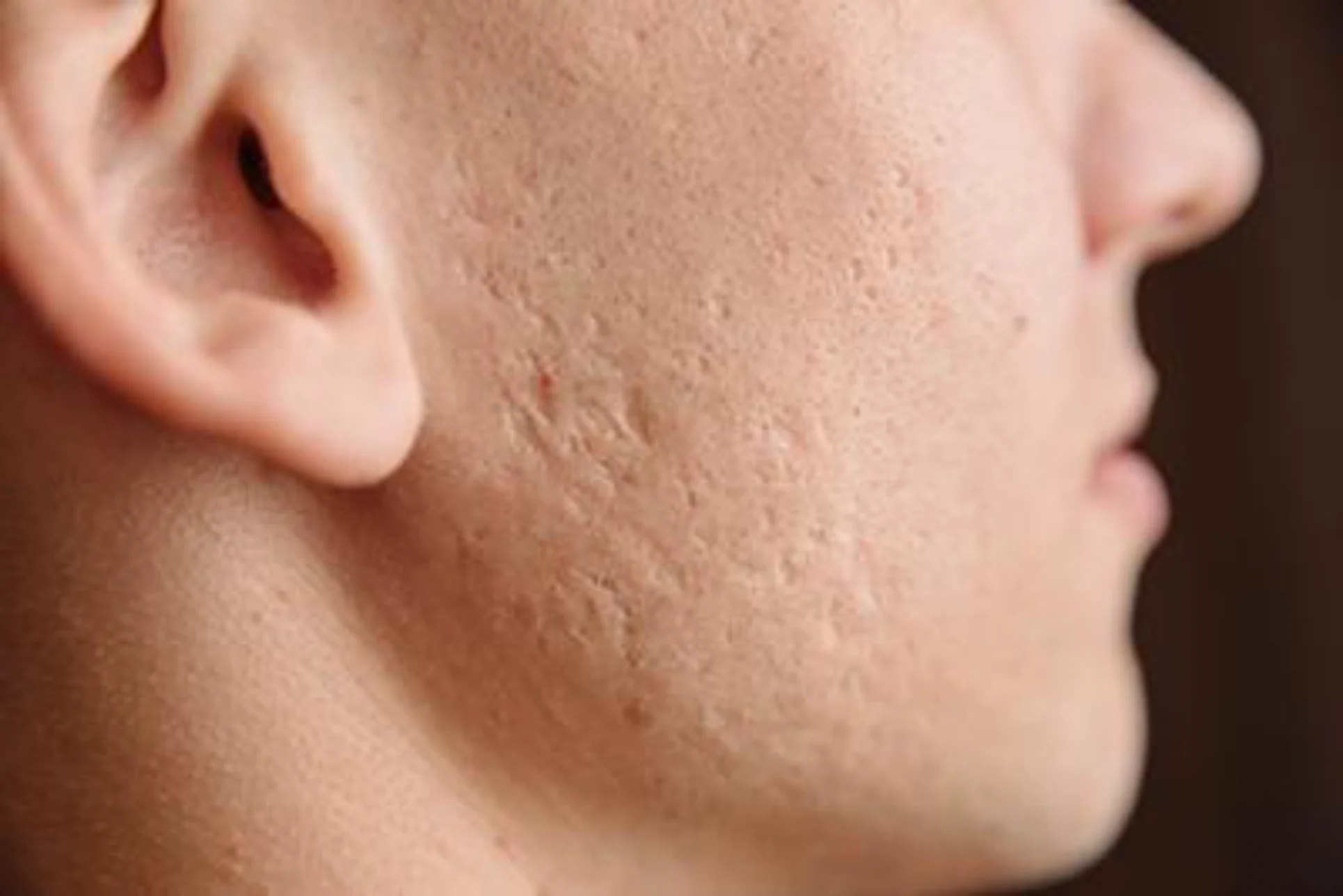 Skin texture treatment for acne scars in Cortland NY