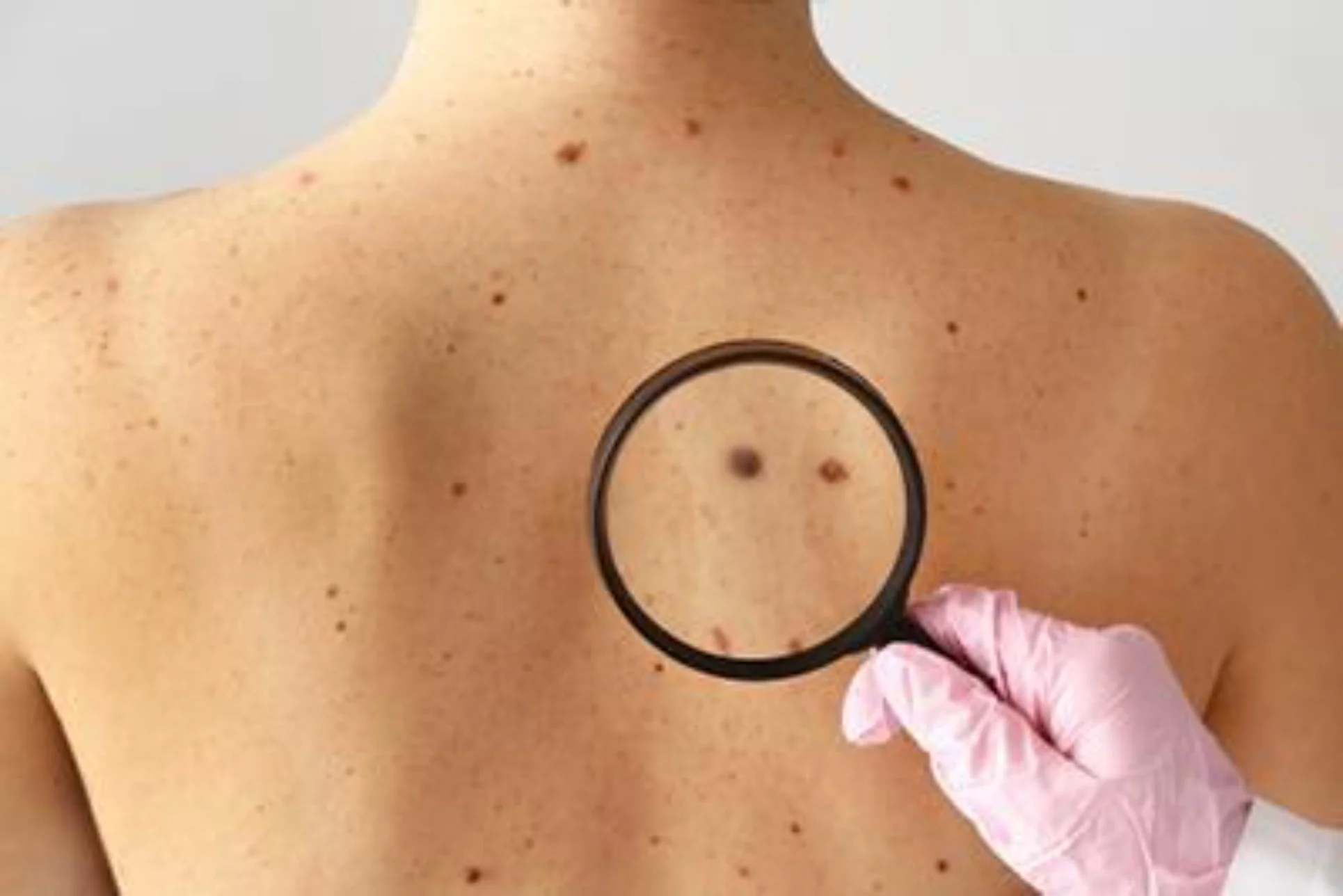 Suspicious mole screening in Ithaca NY