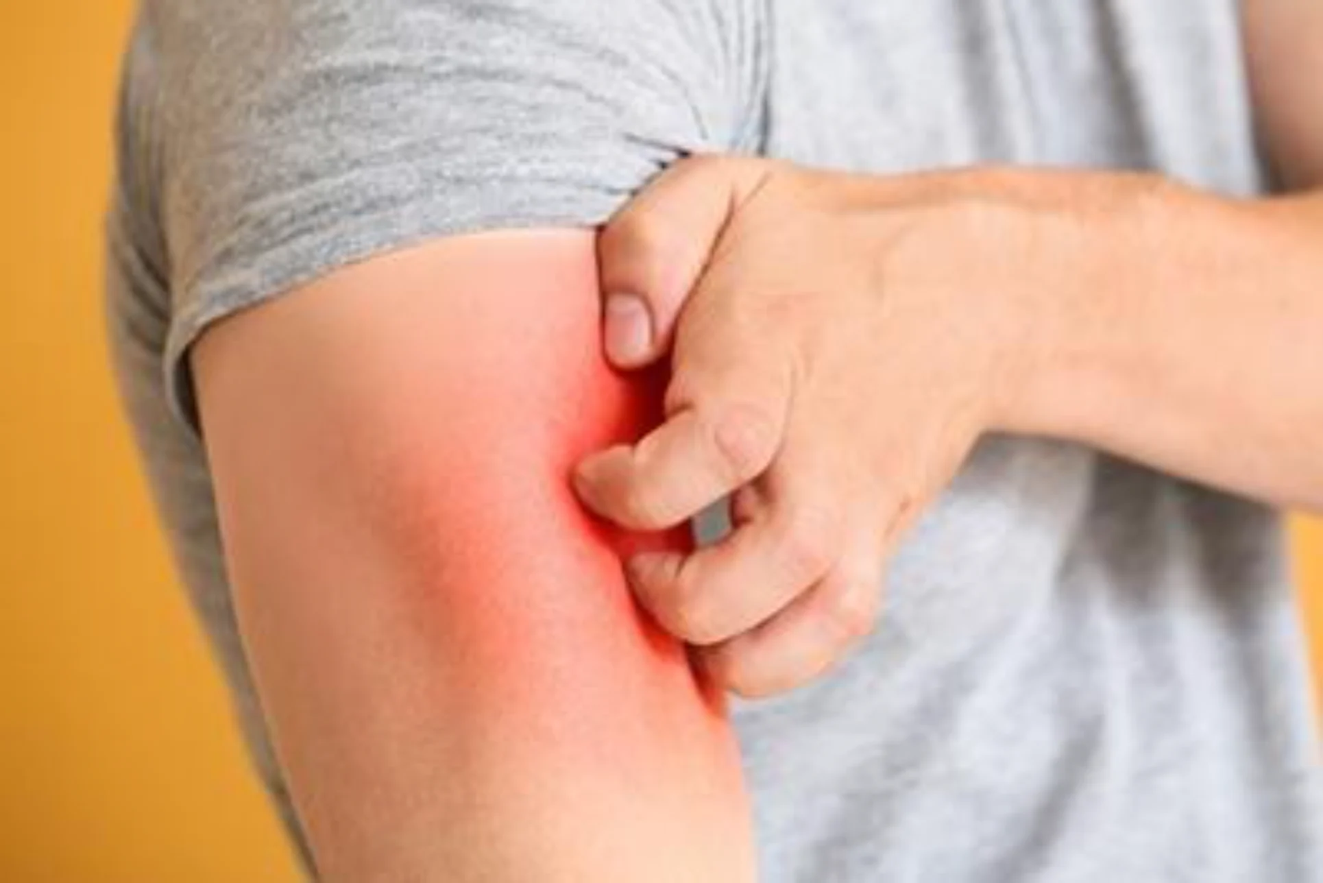 Psoriasis flare treatment in Ithaca NY