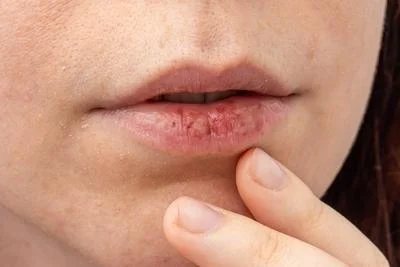 Lip dermatitis treatment in Ithaca NY