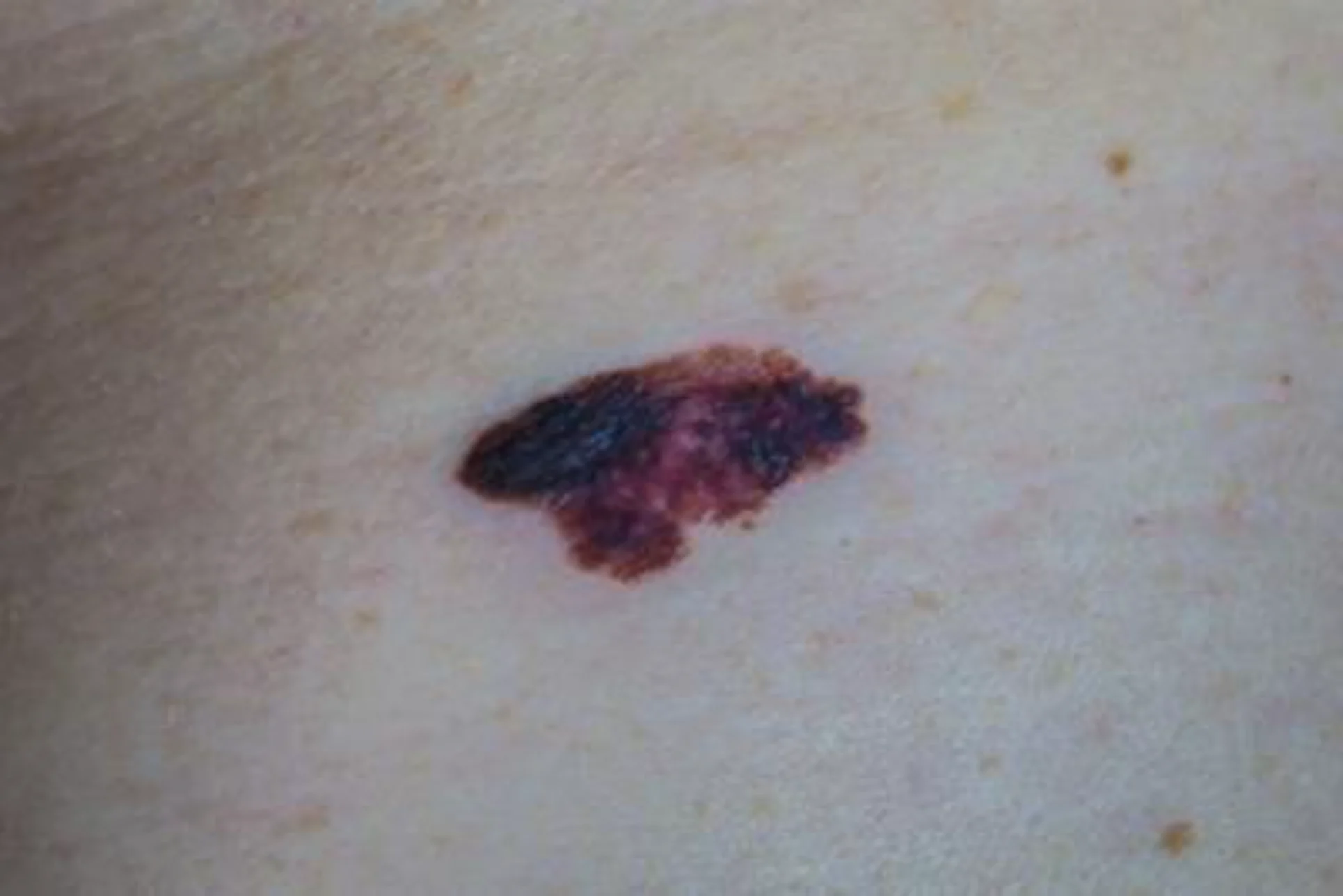 Irregular mole evaluation